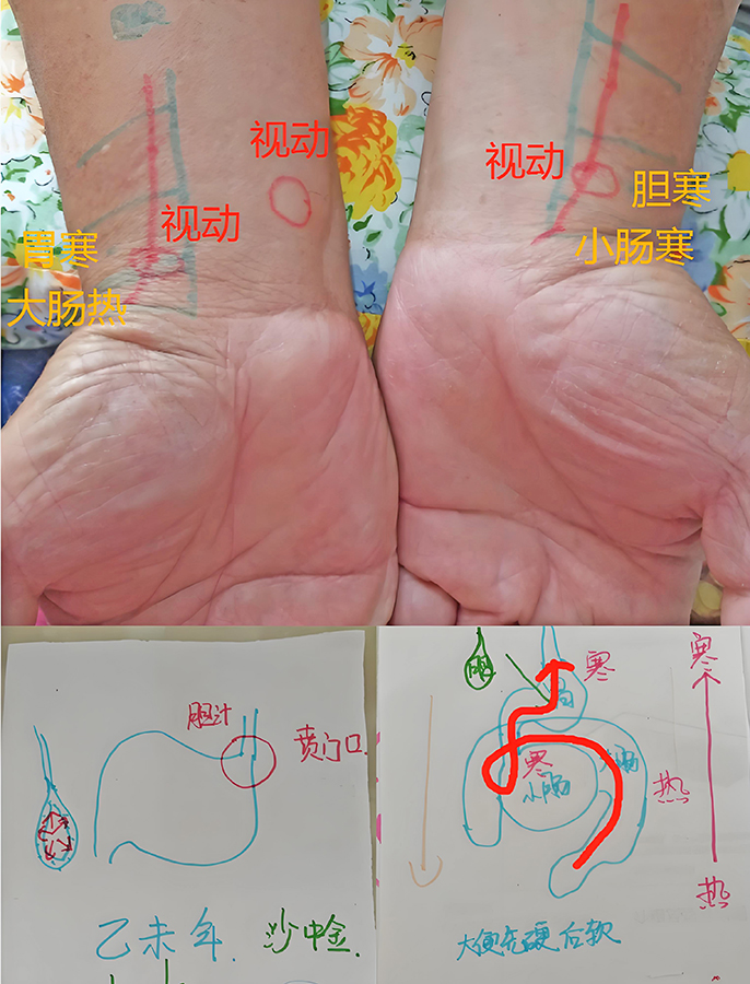 图片[1]-脉诊：大便先硬后溏-善米